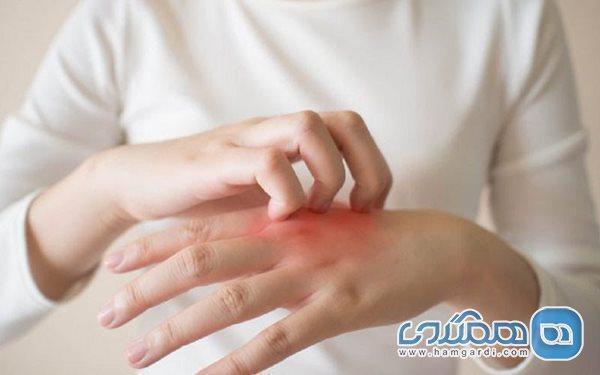 اگزمای دست و پا؛ علائم، پیشگیری و درمان اگزمای دست و پا؛ علائم، پیشگیری و درمان