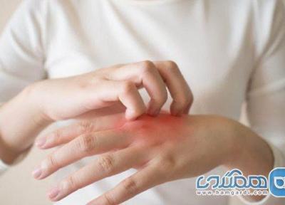 اگزمای دست و پا؛ علائم، پیشگیری و درمان